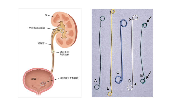 輸尿管支架工作原理及常見的雙J管