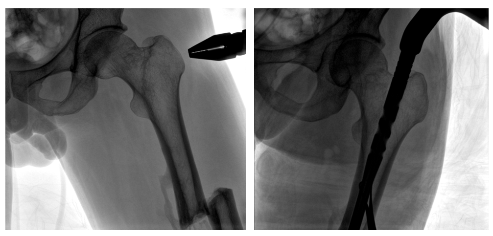 一體式C形臂釘點至骨折部位的臨床影像