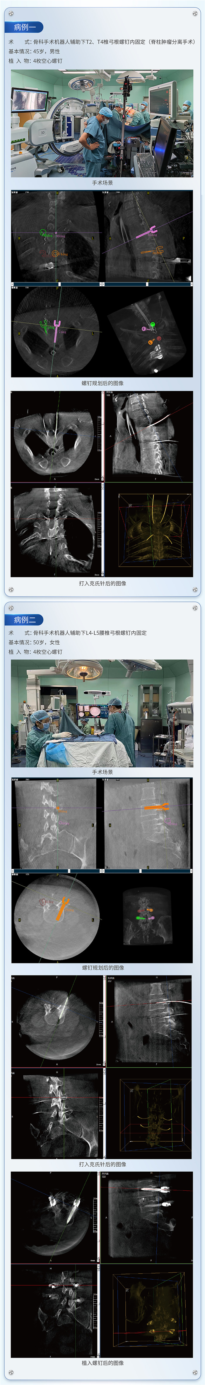脊柱外科手術(shù)導(dǎo)航定位系統(tǒng)應(yīng)用下的病例分享